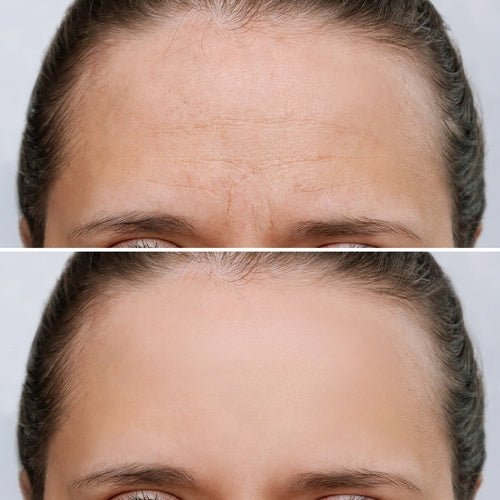 Toxina Botulínica - Cara Bonita Medicina Estetica