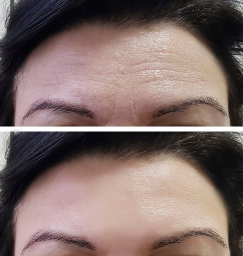 Toxina Botulínica - Cara Bonita Medicina Estetica