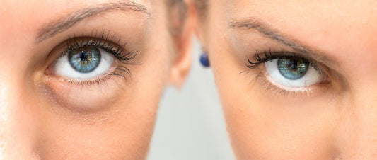 Adiós a las ojeras: Rejuvenece tu mirada con relleno de ácido hialurónico - Cara Bonita Medicina Estetica