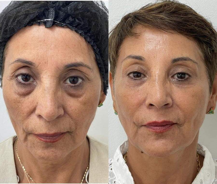 Armonización facial integral en CB Clínica Estética