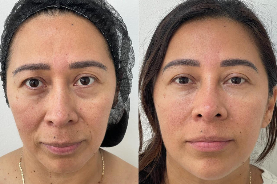 Armonización facial