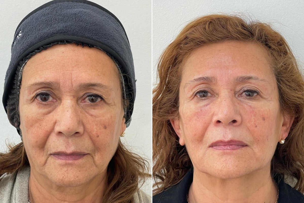 Bioestimuladores faciales de colágeno en CB Clínica Estética