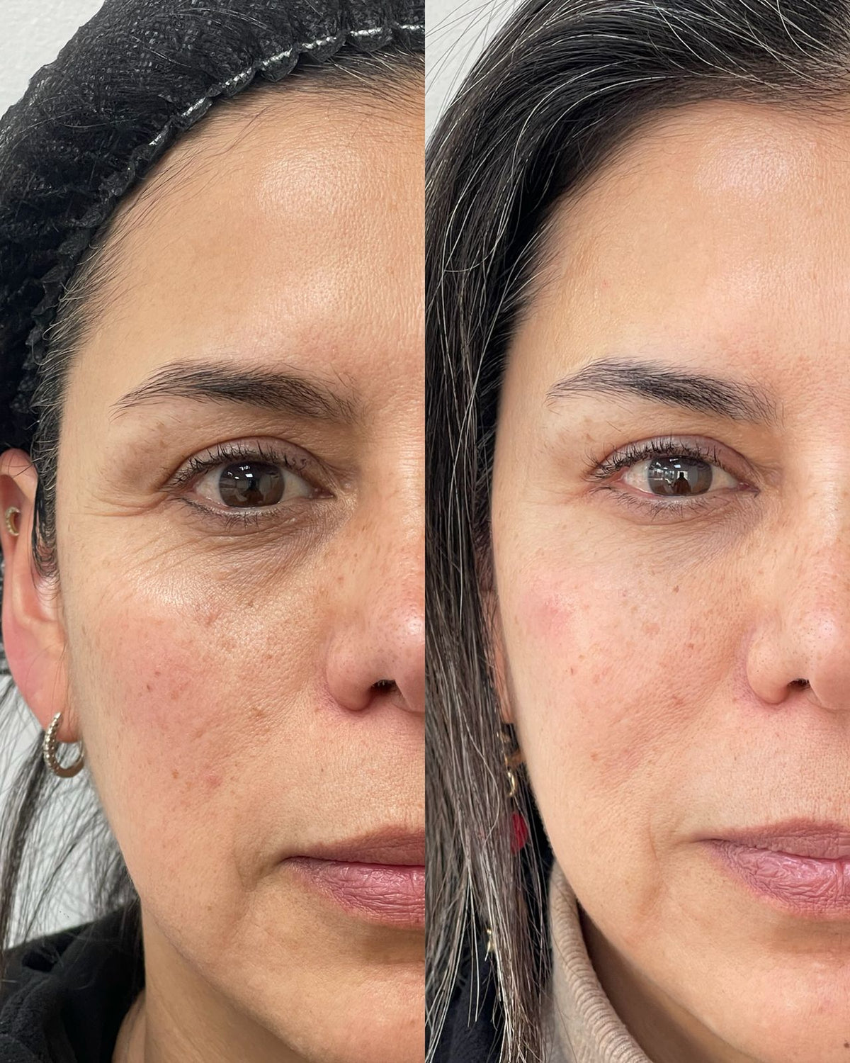 Bioestimuladores faciales de colágeno en CB Clínica Estética