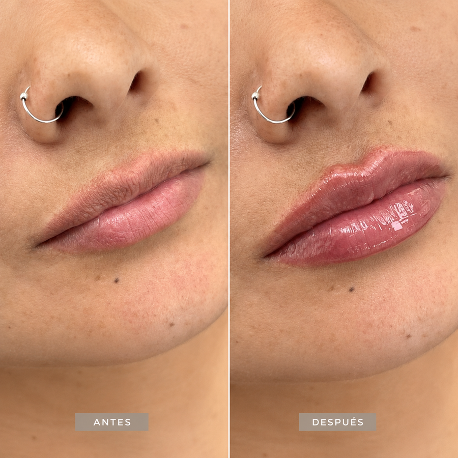 Resultado natural de aumento de labios con ácido hialurónico en CB Clínica Estética