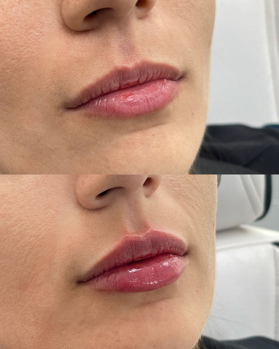 Aumento de labios