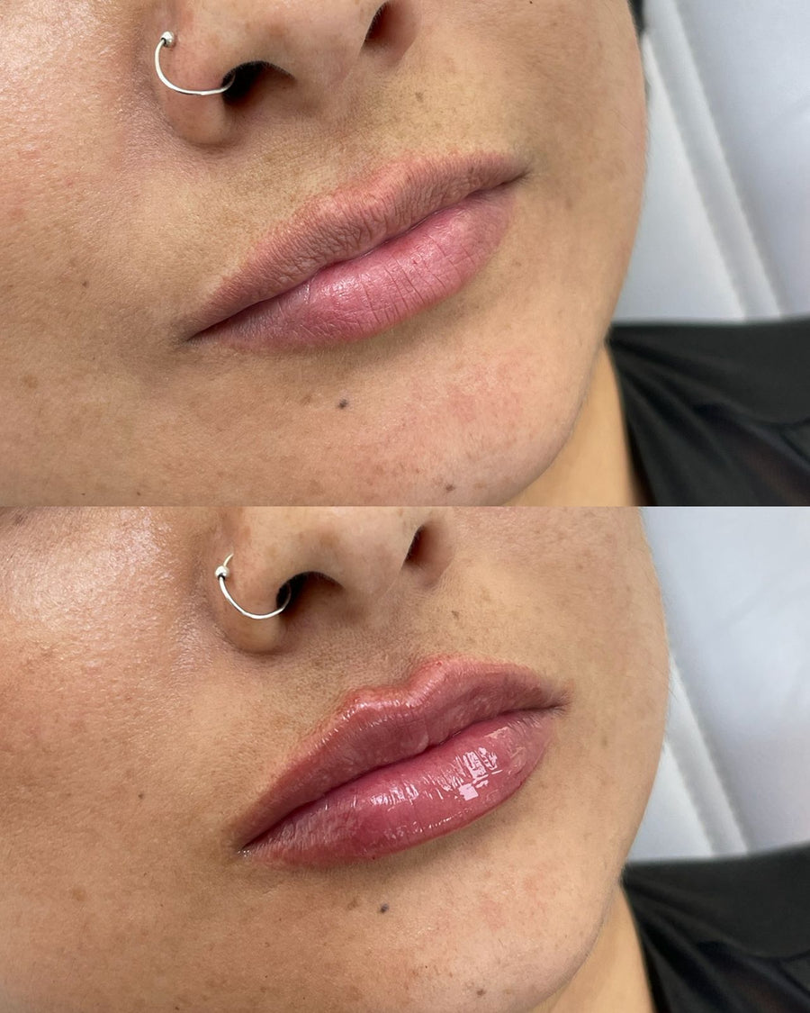 Aumento de labios con ácido hialurónico en CB Clínica Estética