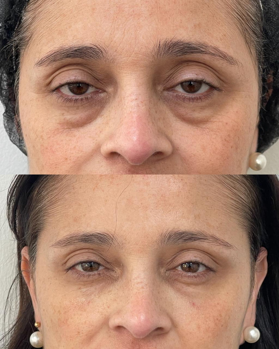 Tratamientos para mirada cansada — ojeras, mesoterapia y bioestimuladores
