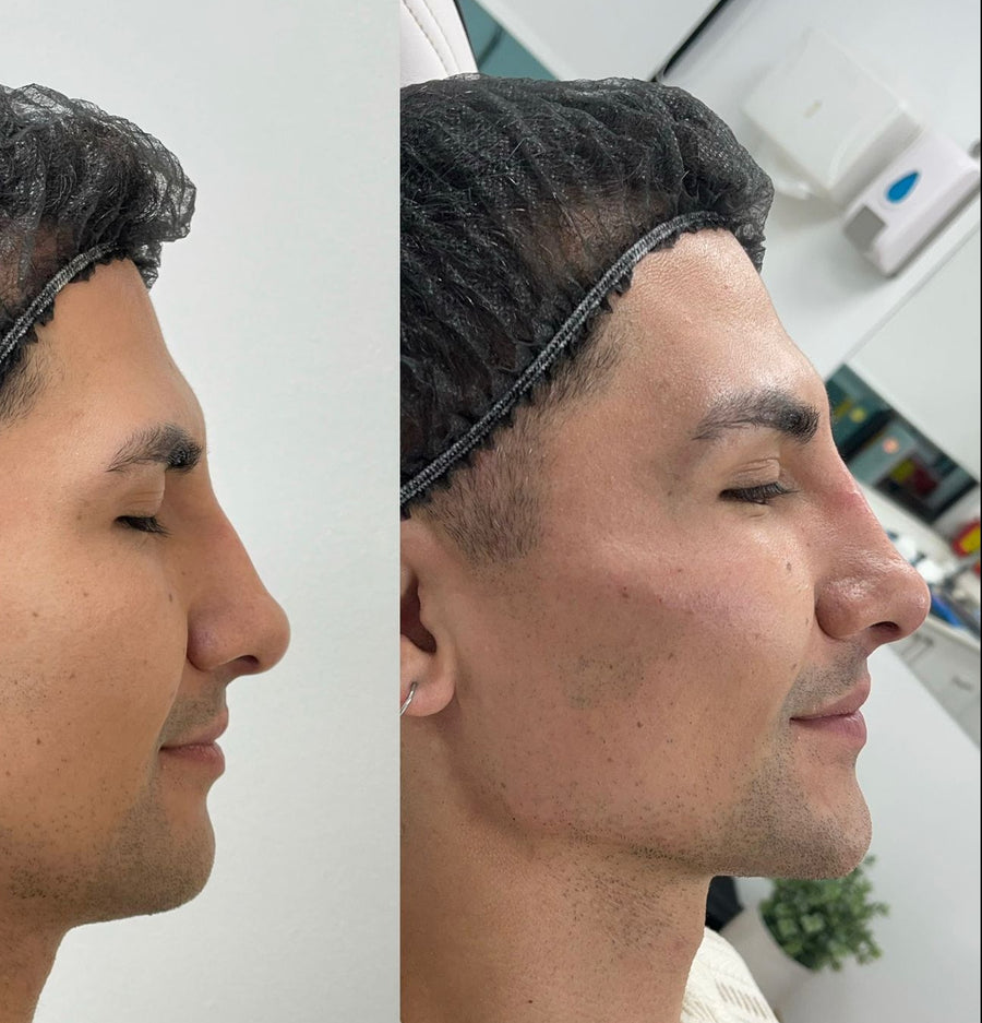 Tratamientos para definir la mandíbula — perfilado y lipopapada