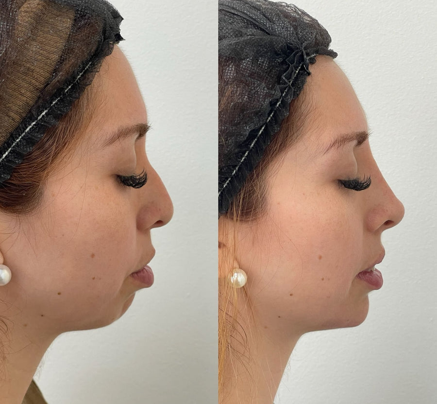 Perfilado mandibular