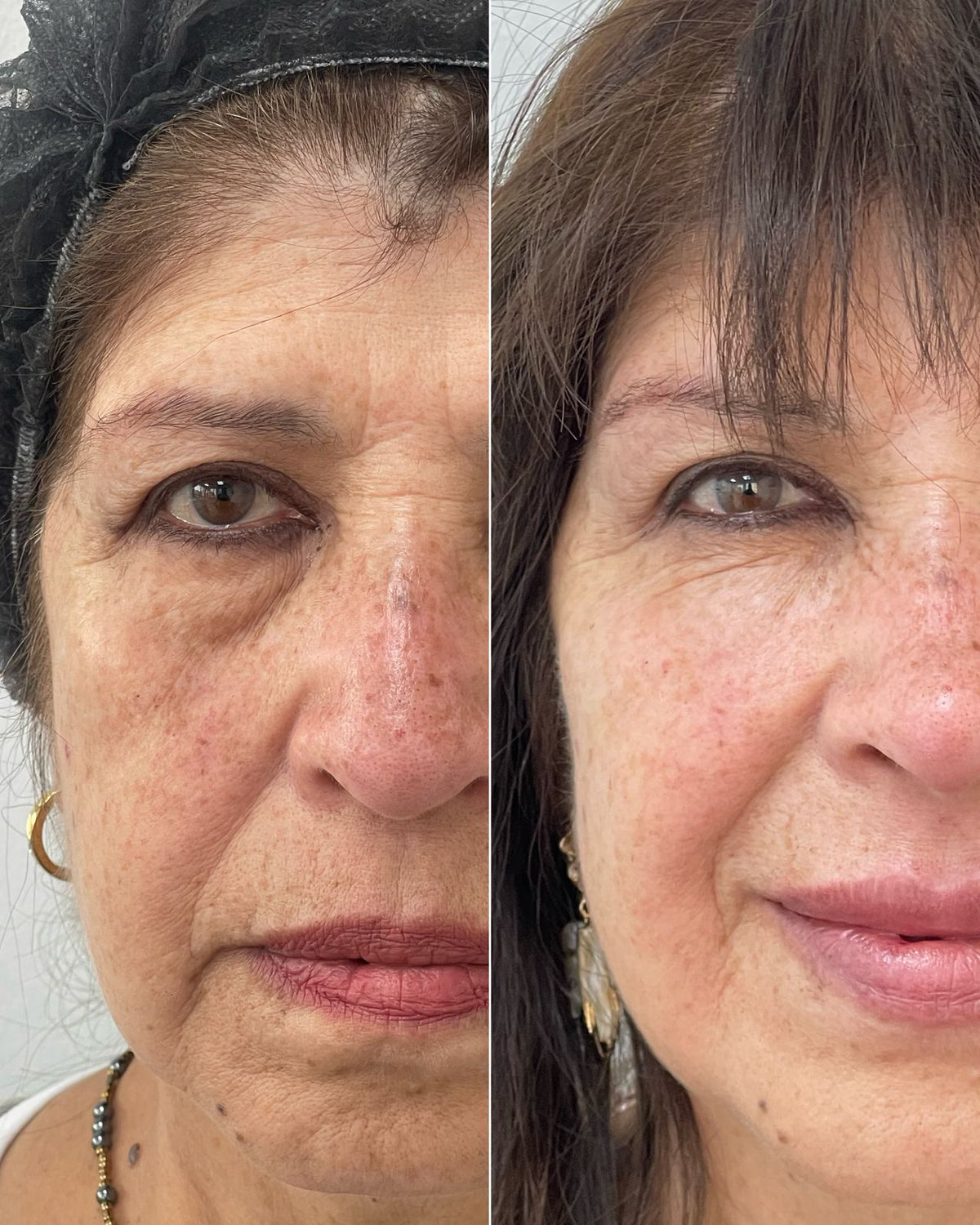 Ácido hialurónico facial en CB Clínica Estética Santiago