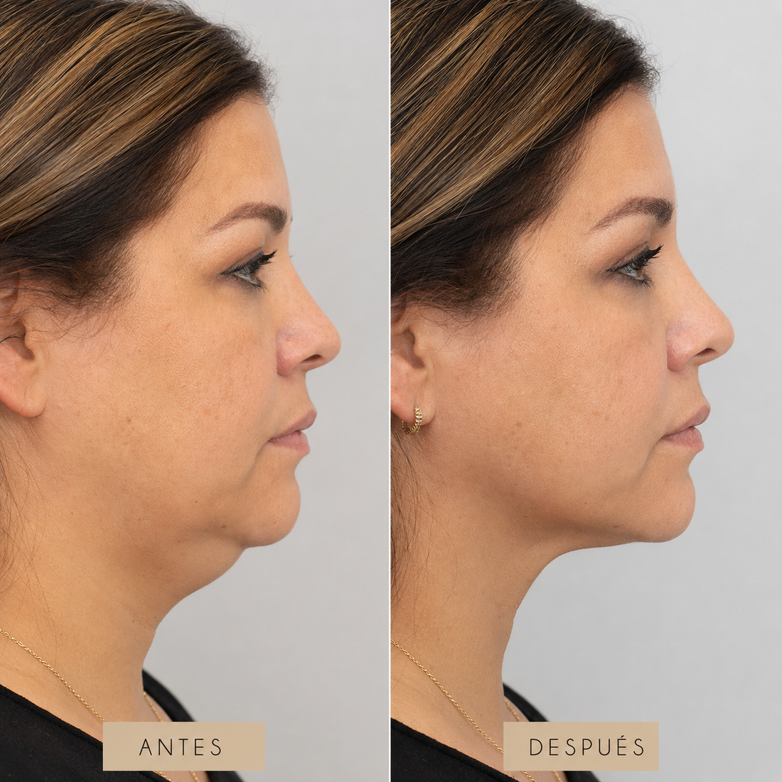 Lipopapada para definición de cuello y mandíbula en CB Clínica Estética
