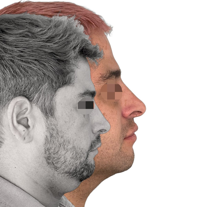 Lipopapada – Cara Bonita Medicina Estetica - Main Image