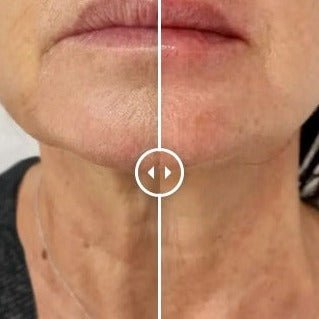 Mesoterapia Facial - Cara Bonita Medicina Estetica